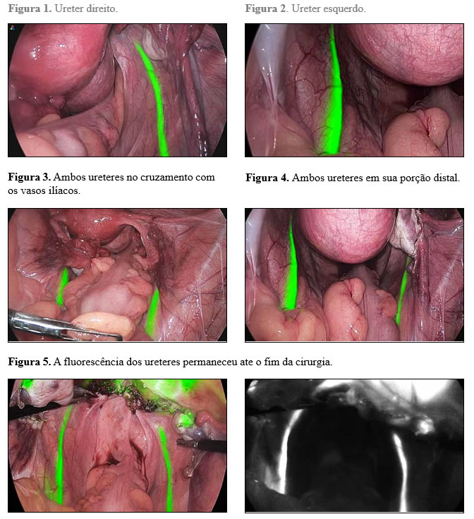 Identificação do Ureter em Tempo Real com Verde de Indocianina em Cirurgia Pélvica Complexa Minimamente Invansiva